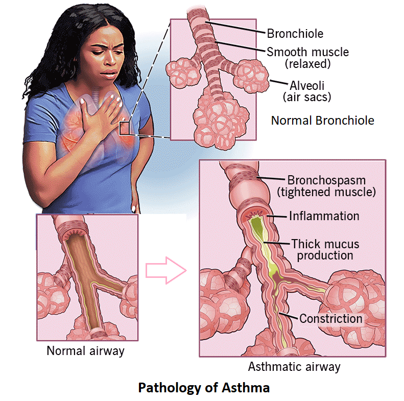 pathology asthama